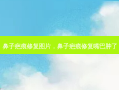 鼻子疤痕修复图片，鼻子疤痕修复嘴巴肿了
