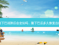 隆下巴消肿后会变短吗，隆下巴后多久恢复自然