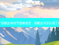割了双眼皮有结节是啥意思，双眼皮术后出现了结节